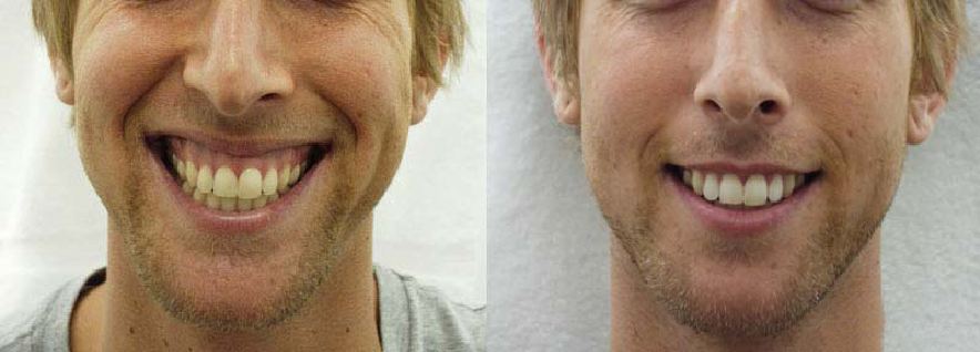 zabieg uśmiech dziąsłowy przed i po