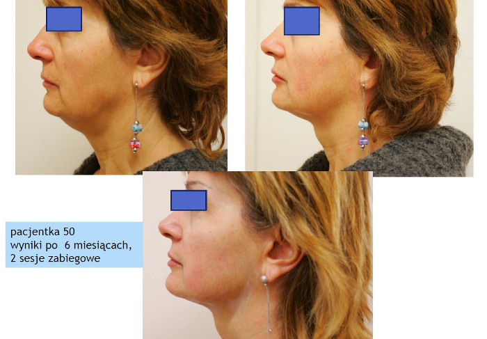 Efekty bezoperacyjnego liftingu twarzy