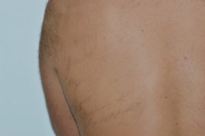 Efekty usuwania owłosienia laserem u mężczyzn
